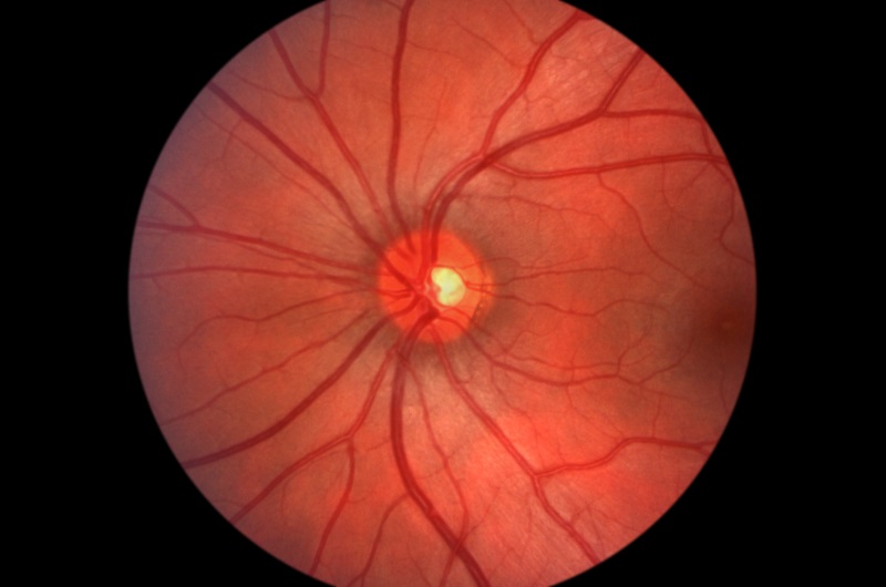 Glaucoma Pleasant Hill, CA